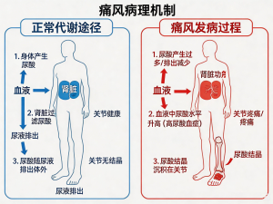 远离痛风困扰，守护居家健康——社区痛风防治科普